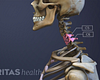 Profile view of the cervical spine with C5-C6 highlighted.