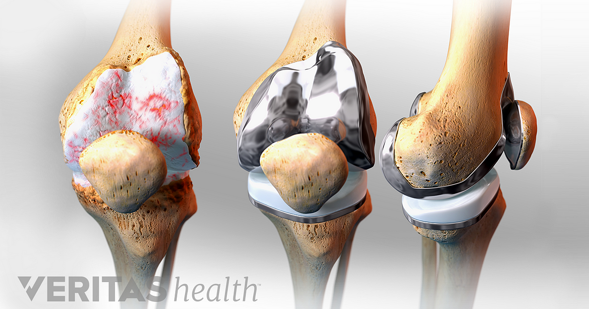 The Pros And Cons Of Double Knee Replacement