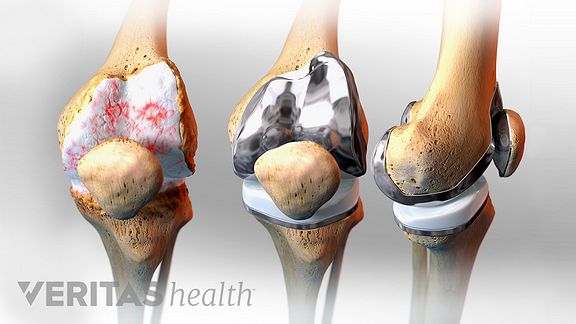 Total Knee Replacement for Knee Arthritis ArthritisHealth