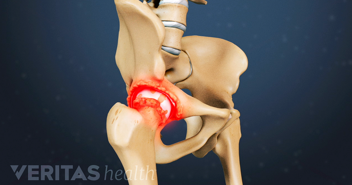 Hip Osteoarthritis Symptoms