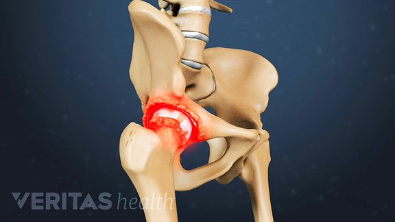 Hip Replacement Surgery >> What To Expect After Hip Replacement Surgery Hip Replacement Surgery >> What To Expect After Hip Replacement Surgery