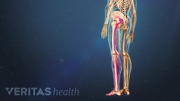Illustration of Sciatic Nerve Pain