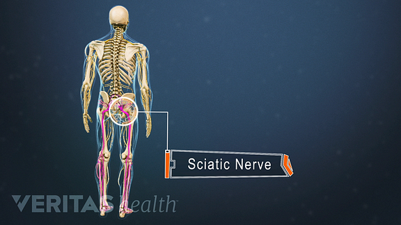 The medical term for sciatica is radiculopathy, which means that the radicular nerve in your lower back has been irritated or pinched