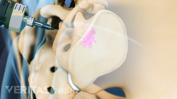 sacroiliac joint injection