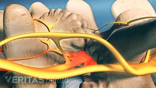 Synovial Cyst Spine Forum