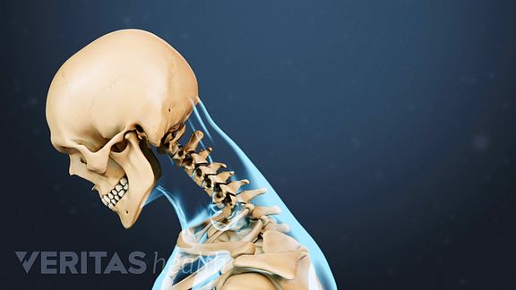 Neck Strains and Sprains Video