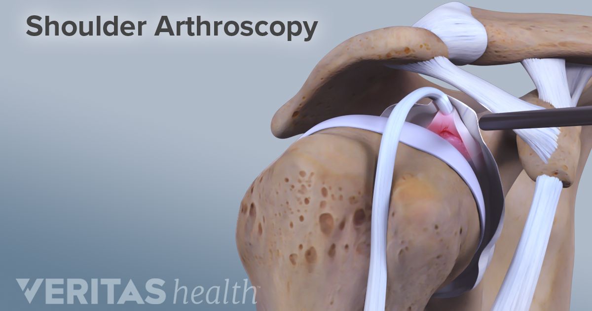 the performance of arthroscopic shoulder surgery to speed up healing of shoulder injuries After shoulder injuries and shoulder surgery learn a few shoulder stretches and exercises menu rehab exercises for shoulder pain share pin email search the site go more in orthopedics physical therapy exercises can speed the recovery of a sore shoulder caiaimage/trevor adeline. the performance of arthroscopic shoulder surgery to speed up healing of shoulder injuries After shoulder injuries and shoulder surgery learn a few shoulder stretches and exercises menu rehab exercises for shoulder pain share pin email search the site go more in orthopedics physical therapy exercises can speed the recovery of a sore shoulder caiaimage/trevor adeline.