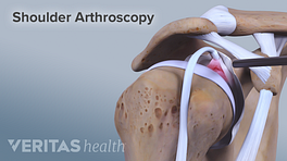 Anterior view of a shoulder arthroscopy