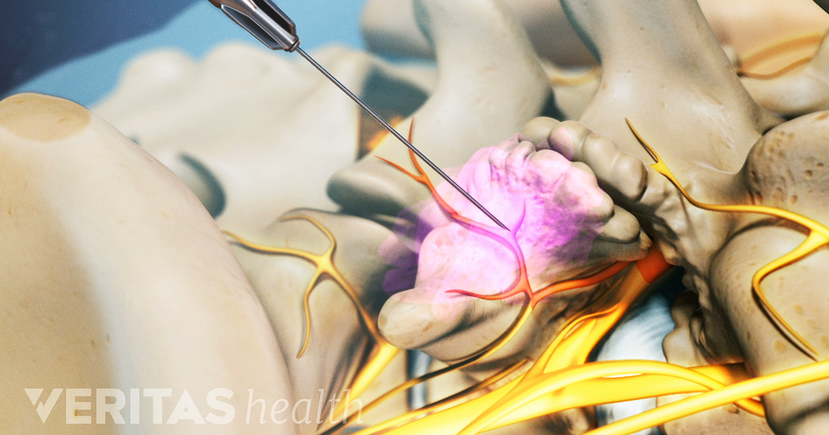 therapeutic nerve blocks for neuropathy