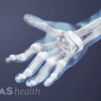 Palmar view of a hand with rheumatoid arthritis in the joints.