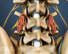 The lumbar posterolateral gutter fusion process is repeated on either side of the spine so both sides can fuse.