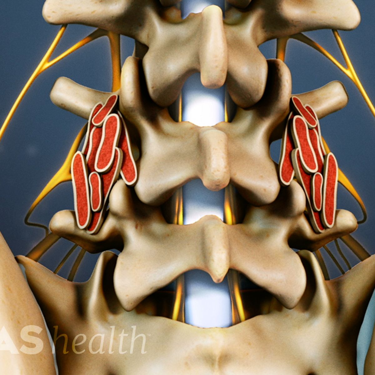 A Visual Guide to Posterolateral Gutter Fusion Surgery