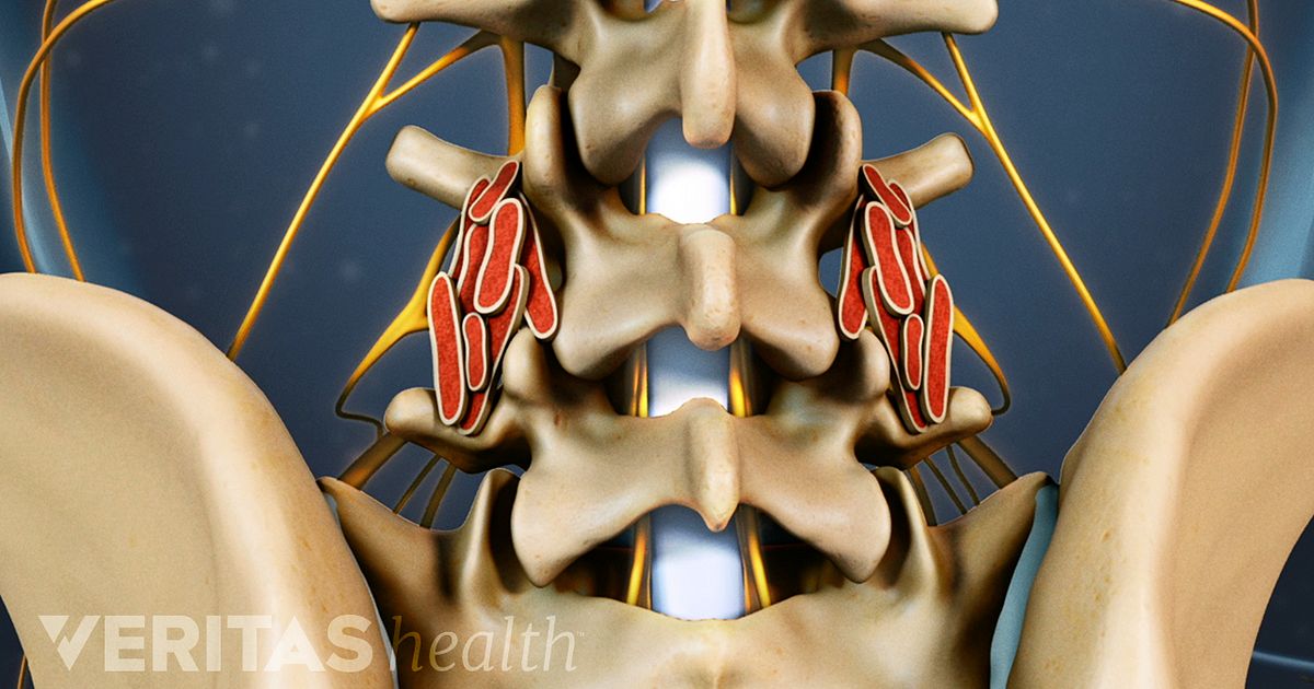 neck fusion problems years later neck fusion problems years later