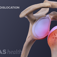 Medical illustration of an anterior shoulder dislocation