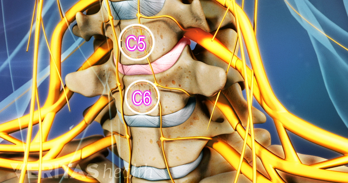 C5 C6 Treatment