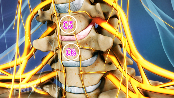 video animat al segmentului vertebral C5-C6