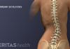 Scoliosis