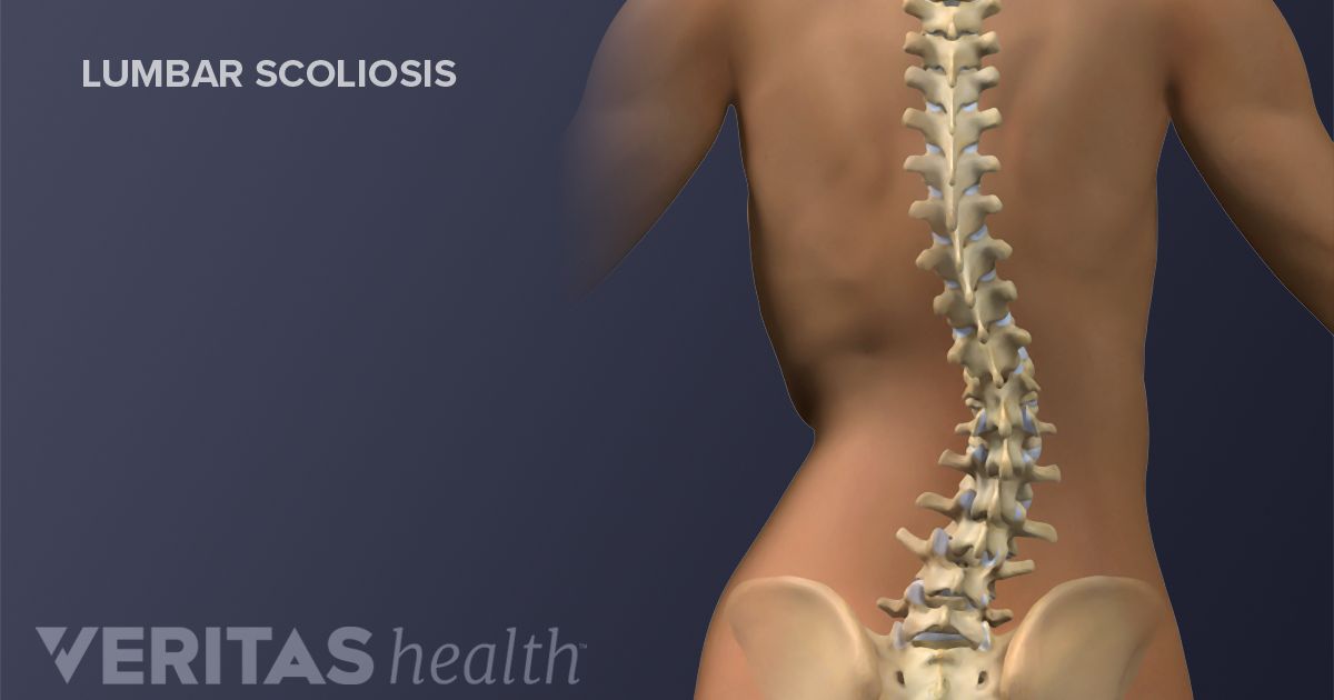 no you bad why exercise for is Degenerative All About Scoliosis no you bad why exercise for is Degenerative All About Scoliosis
