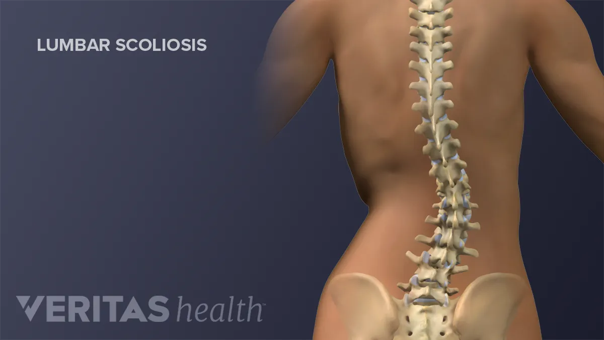 Treatment for Adult Scoliosis