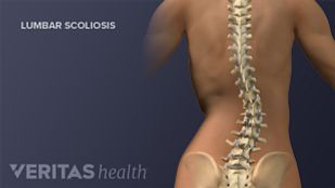 Scoliosis