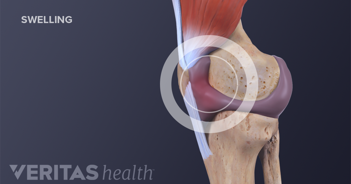 What Causes a Swollen Knee (Water on the Knee)?