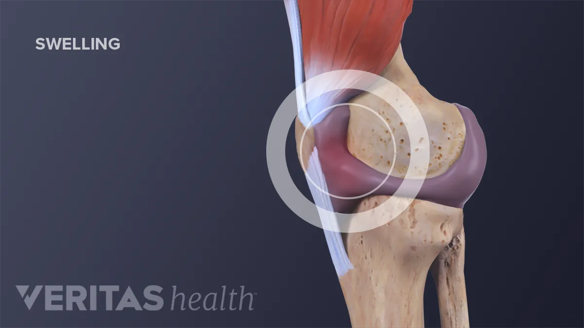 Medial Knee Pain (Inside) - Symptoms, Causes, Treatment & Rehab