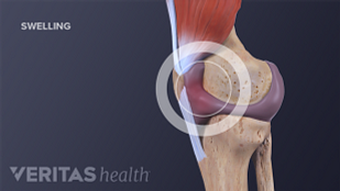 Crepitus in the Knee