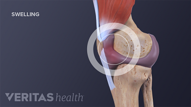 Knee Effusion Treatments: Remedies, Exercises For Water On The Knee