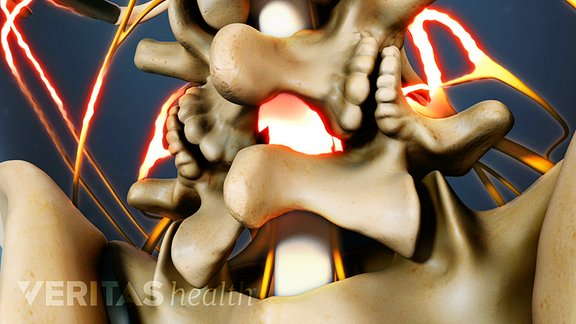 Profile view of lumbar spinal stenosis laminectomy.