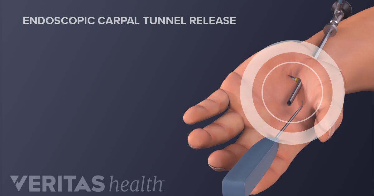 Carpal Tunnel Surgery >> Surgery For Carpal Tunnel Syndrome Carpal Tunnel Surgery >> Surgery For Carpal Tunnel Syndrome