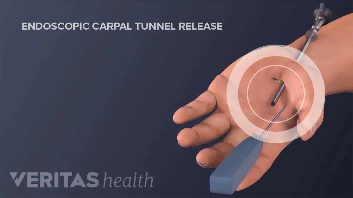 Pros & Cons of Endoscopic Surgery for Carpal Tunnel
