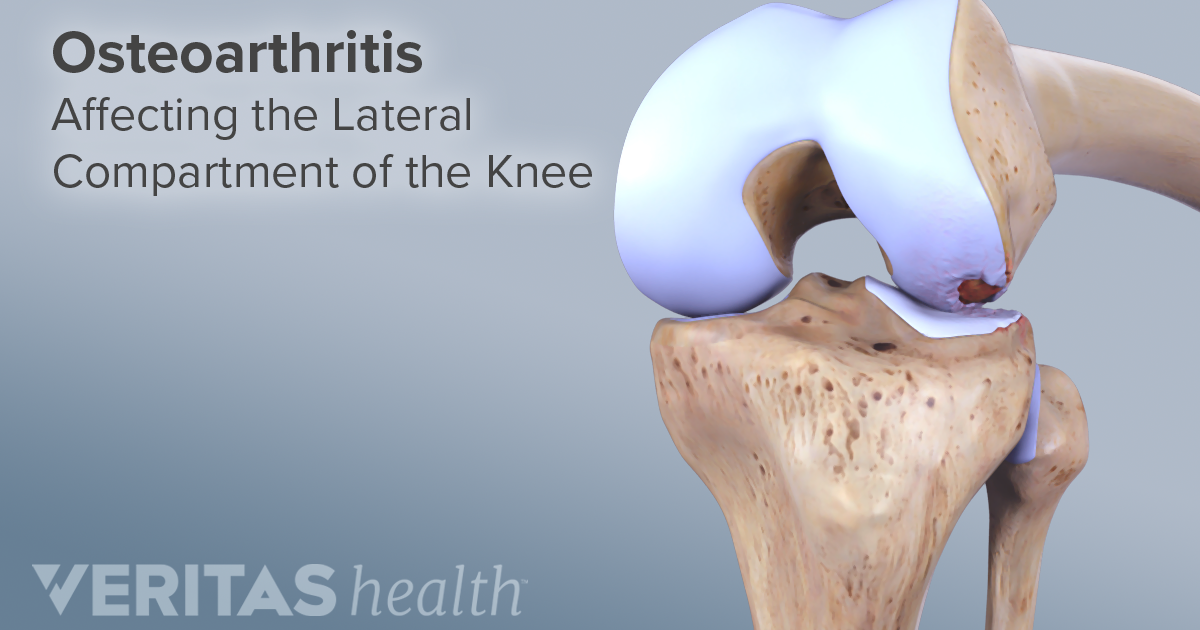 lateral-definition-defined-by-arthritis-health