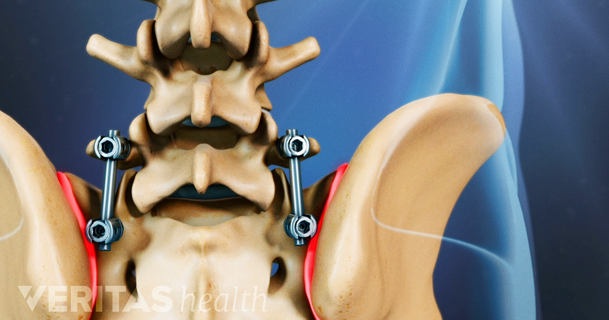 Is Lumbar Fusion Surgery A Reliable Procedure