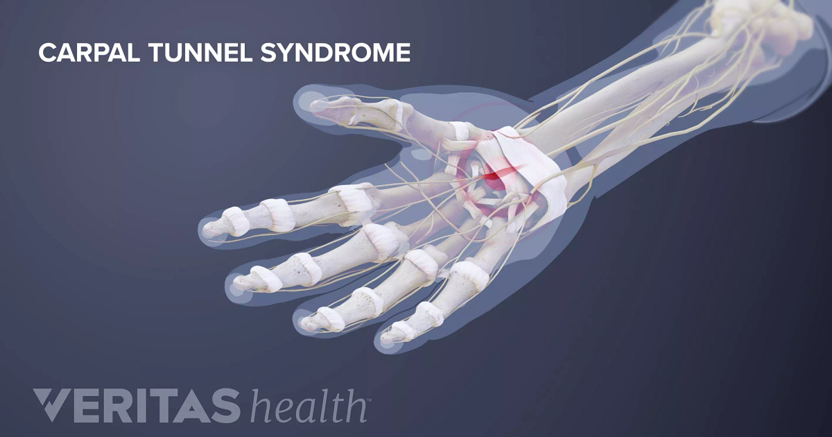 Carpal Tunnel Syndrome Definition Defined By Arthritis Health 1119