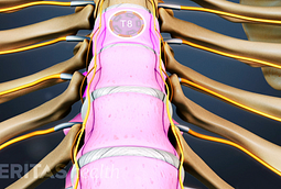 Thoracic Disc Herniation Treatment