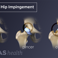 Illustration of the three types of hip impingement: pincer, cam, and combined
