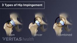 Types of hip impingement include cam, pincer, and combined.
