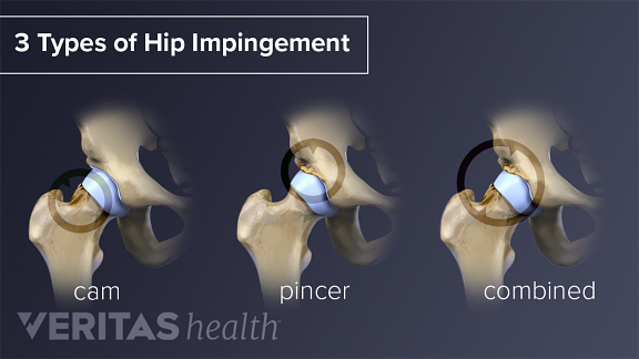 Illustration of the three types of hip impingement: pincer, cam, and combined