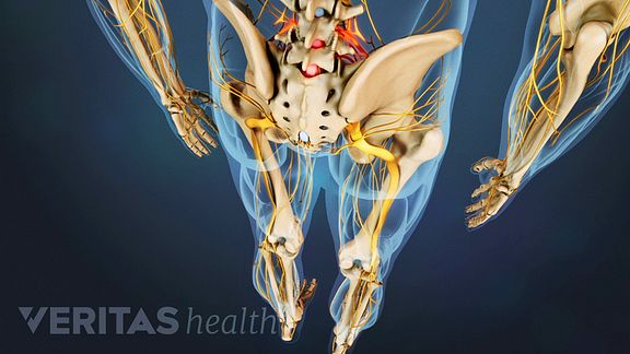 Is it sciatic pain or referred pain?
