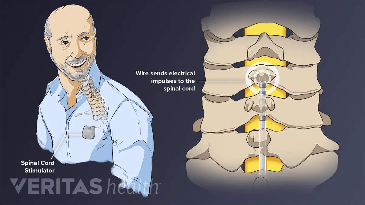 Spinal Cord Stimulator for Treating Chronic Back Pain