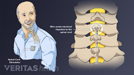 Illustration of man with spinal cord stimulator in his front pocket. Illustration of wire send electrical impulses to the spinal cord.
