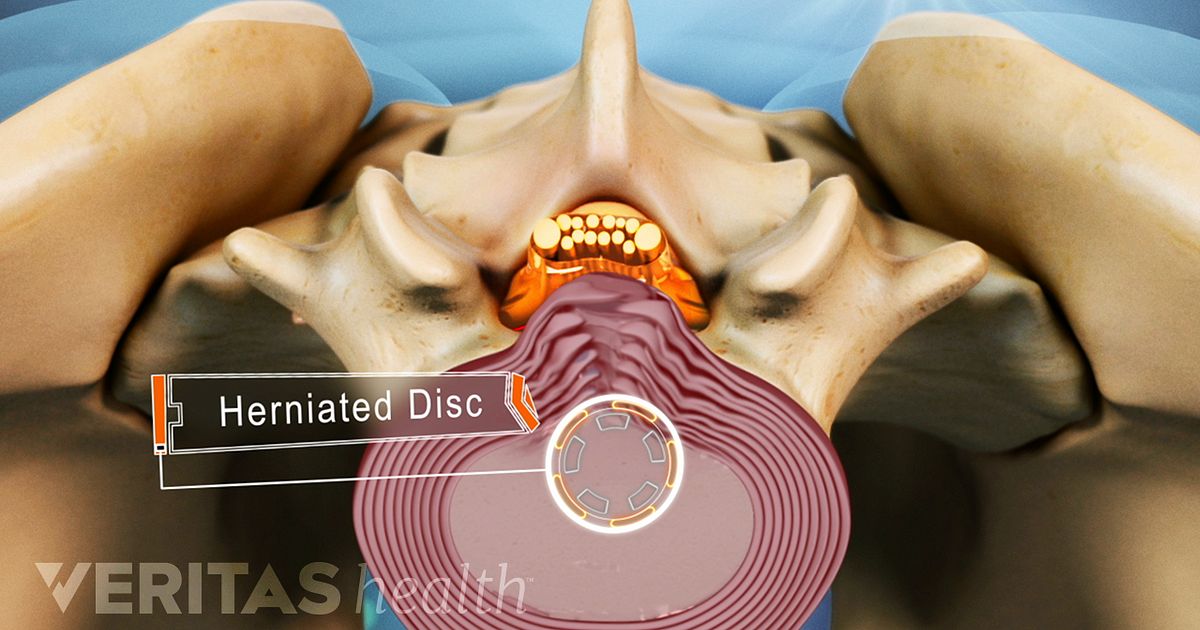 Osteomyelitis, a Spinal Infection