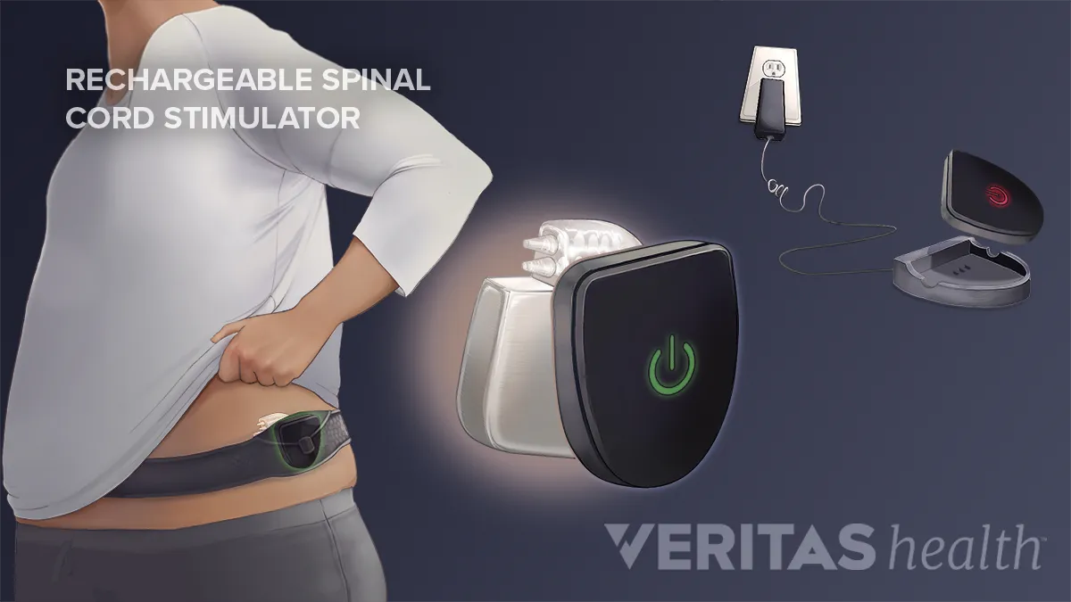 Rechargeable Spinal Cord Stimulators for Chronic Pain