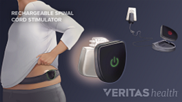 Medical illustration of an implanted generator for spinal cord stimulation