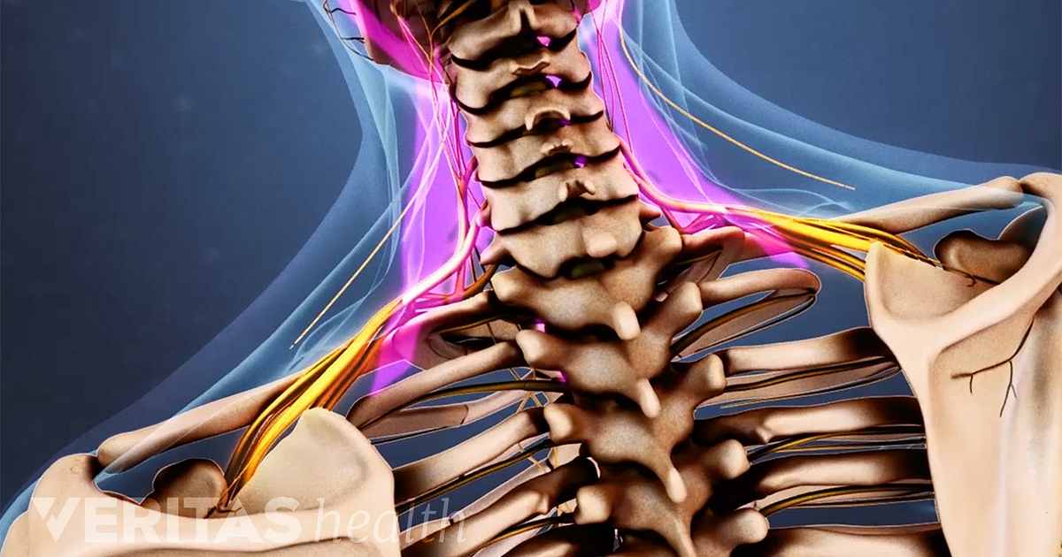 radiating neck pain