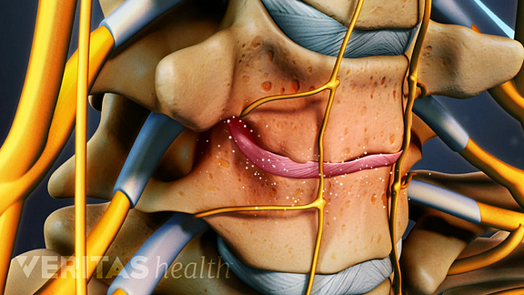 Cervical Degenerative Disc Disease