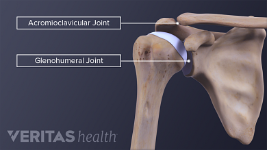 clavicularis acromialis arthrosis