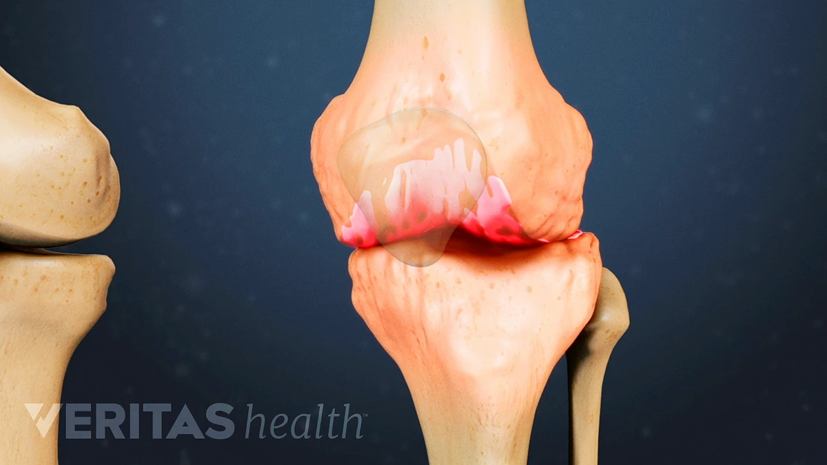 5 Common Causes of Hip Pain and joint pain supplements
