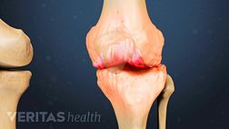 Knee Osteoarthritis Supplements