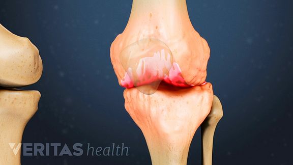 pain in knee cap area